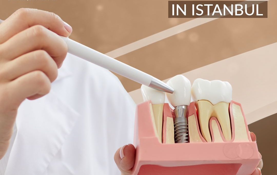 Dental implants in Turkey