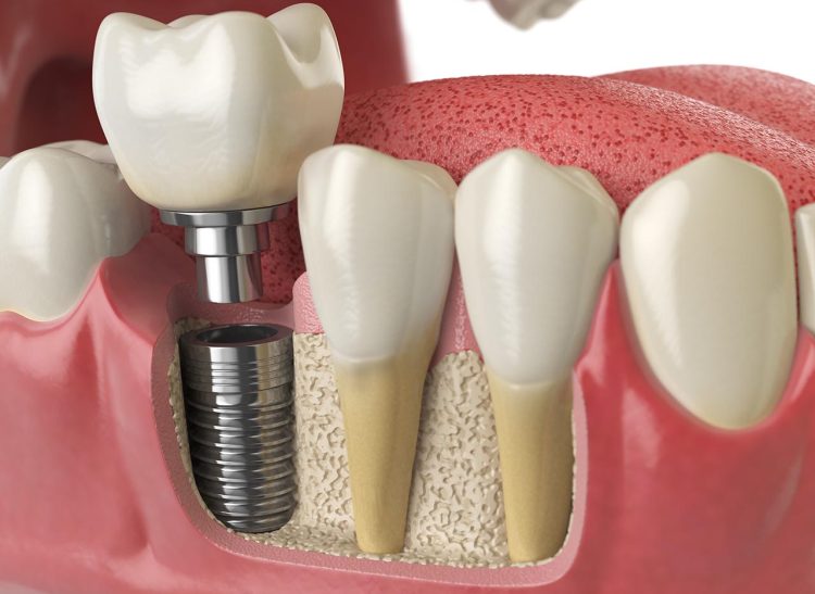 Anatomy of healthy teeth and tooth dental implant in human dentura. 3d illustration