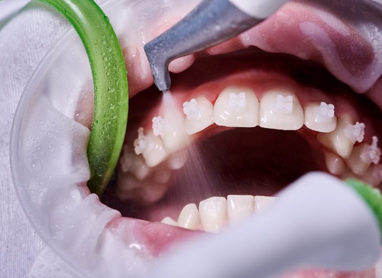 Macro photography. Top view on cleaning process in patient's mouth. Cleaning teeth with water jet and saliva ejector. Cheek retractor on the mouth. Concept of professional dental hygiene